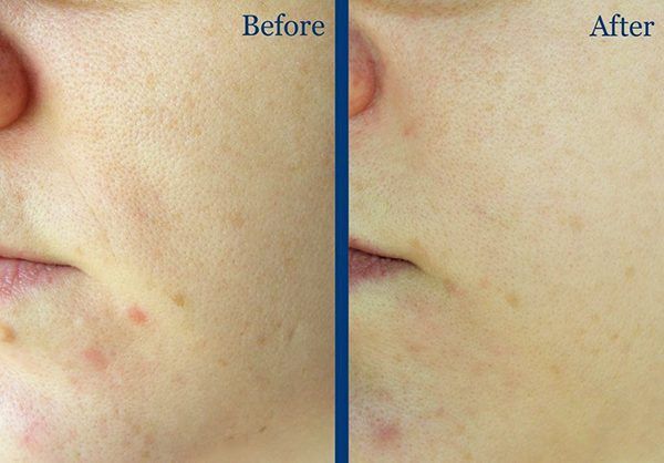 Clinical 1% Retinol Treatment – Paula’s Choice