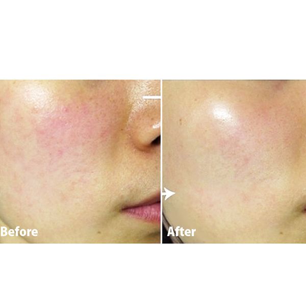 Kem Dưỡng Làm Mờ Đốm Nâu Dr.Jart+ V7 Vitalaser 2.1
