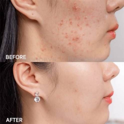  Kem Trị Mụn, Mờ Thâm Acne-Derm Kwas Azelainowy 20% 