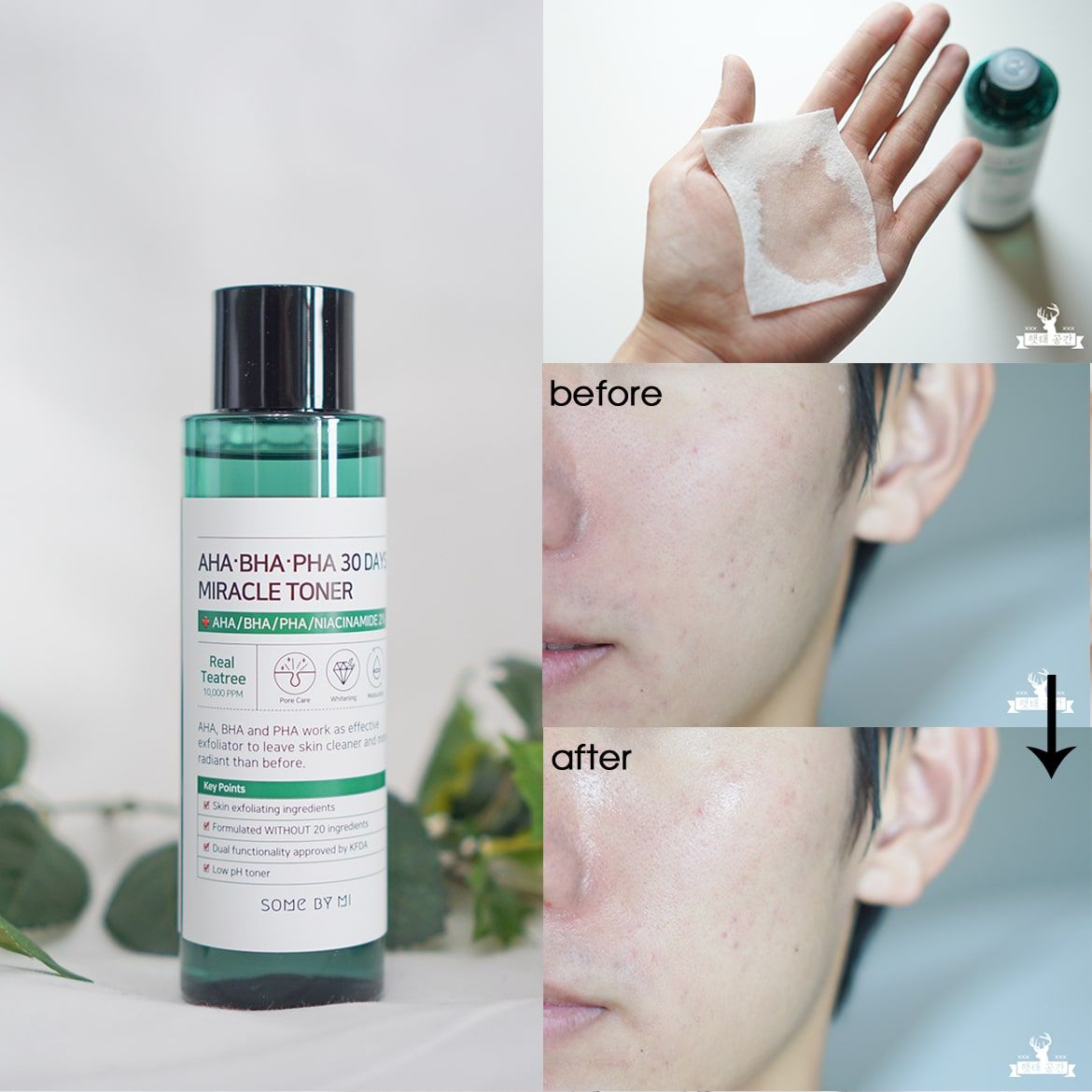  Nước Hoa Hồng Trị Mụn Some By Mi AHA-BHA-PHA 30 Days Miracle Toner 150ml 