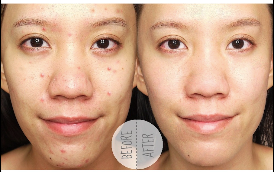 Gel Trị Mụn Ẩn, Giảm Thâm KLENZIT MS Adappalene 0.1% - 15g