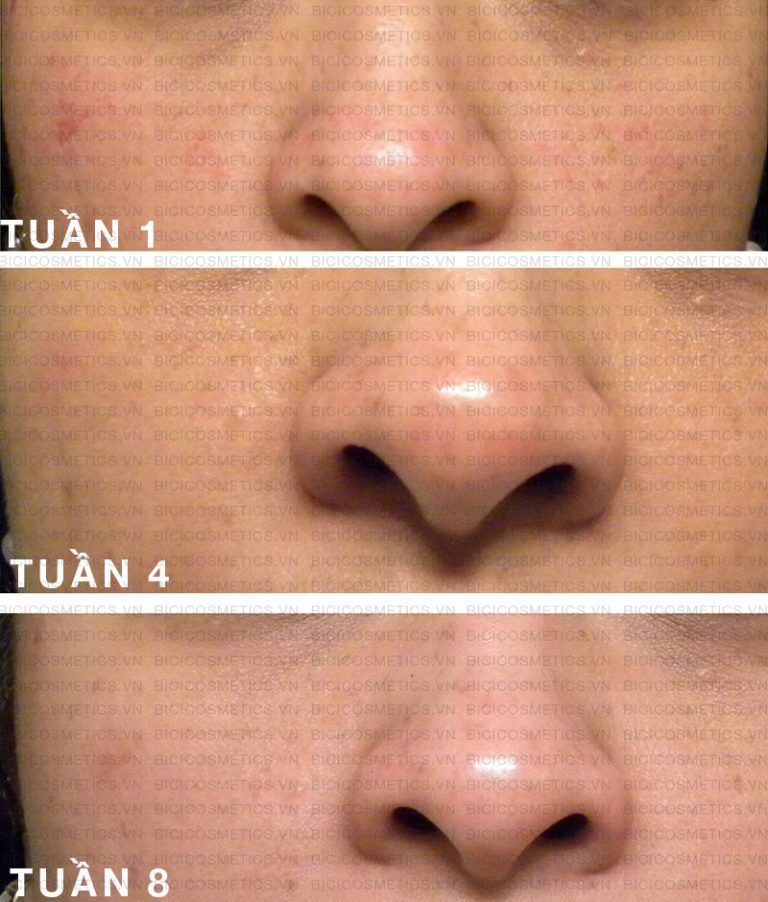 Serum The Ordinary Niaciamide 10% + Zinc 1%