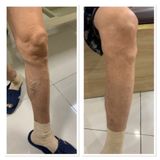 Máy nén ép trị liệu suy giãn tĩnh mạch chân Kachi MK394
