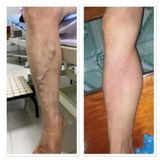 Máy nén ép trị liệu suy giãn tĩnh mạch chân Kachi MK394