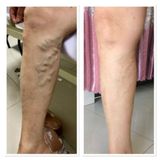 Máy nén ép trị liệu suy giãn tĩnh mạch chân Kachi MK394