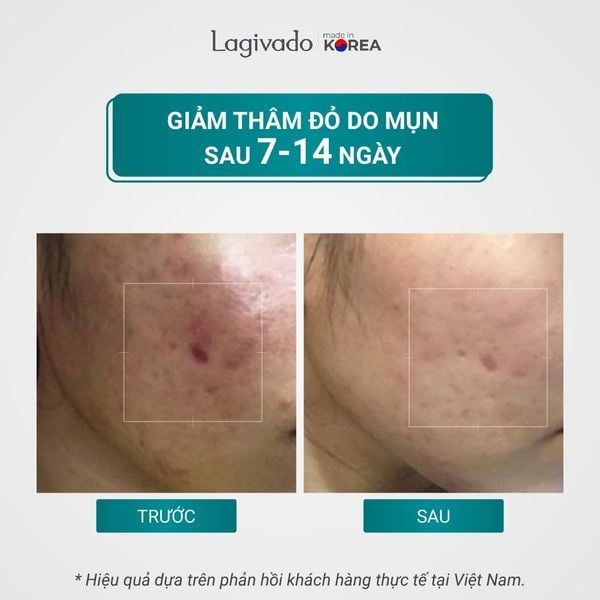 [Nhập mã LAGI100K giảm 100K] Tinh chất serum giảm mụn, mờ thâm, ngừa sẹo rỗ Hàn Quốc Lagivado Dr. ATreat Serum 30 ml