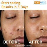  Trị mụn Acnefree Clear Skin System USA. NEW! 