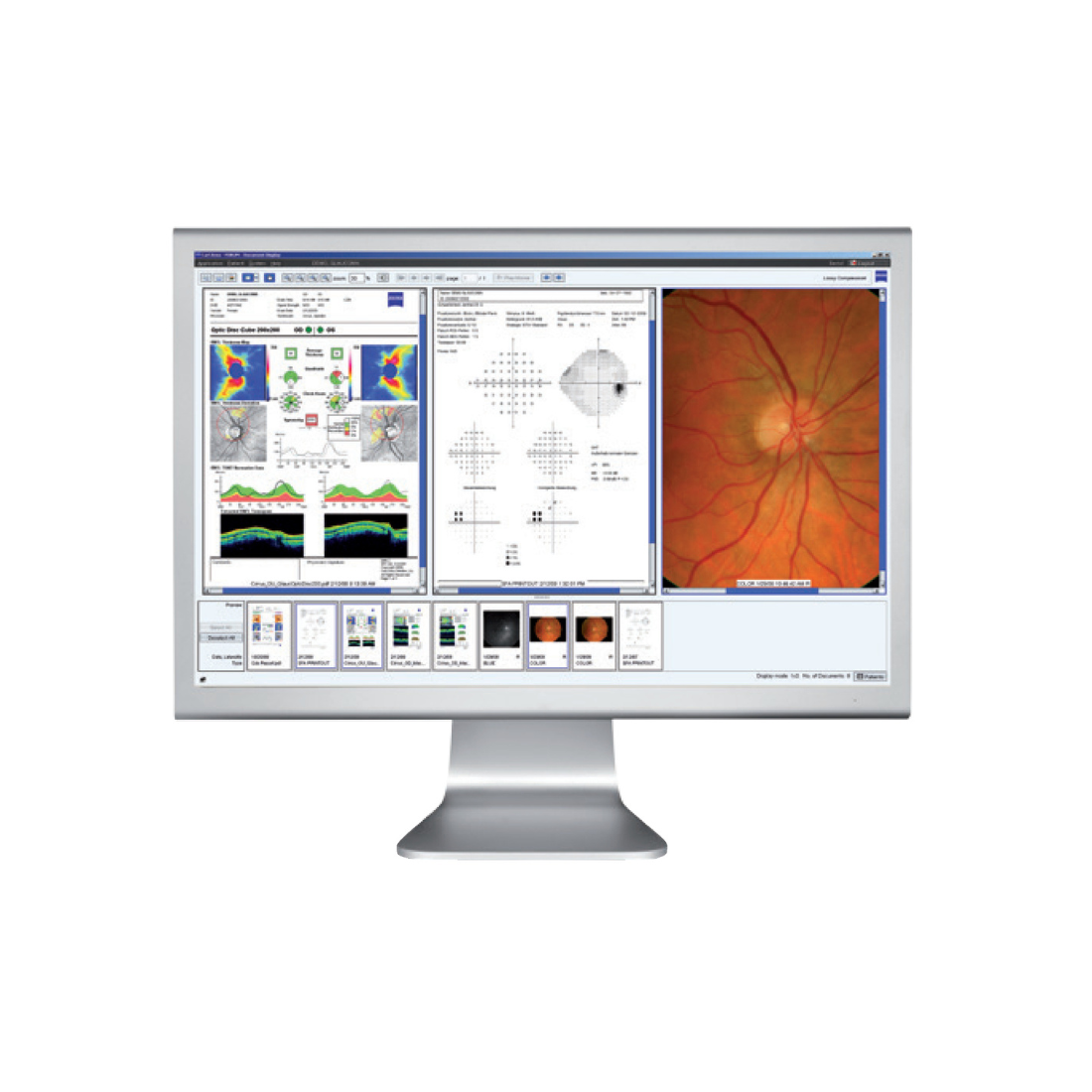 Giải pháp số Zeiss glaucoma workflow - Glaucoma workpalce
