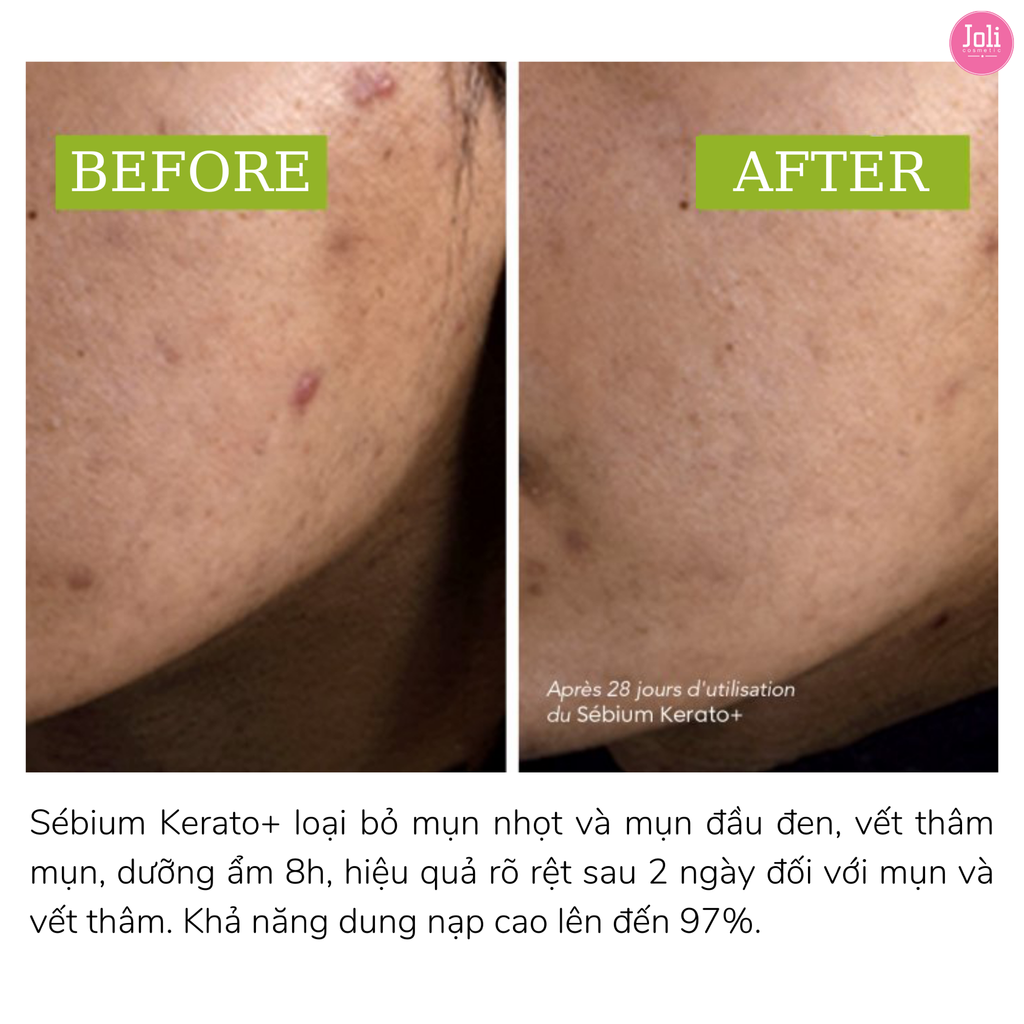 Kem Dưỡng Giảm Mụn Và Thâm Mụn Bioderma Sébium Kerato+ 30ml