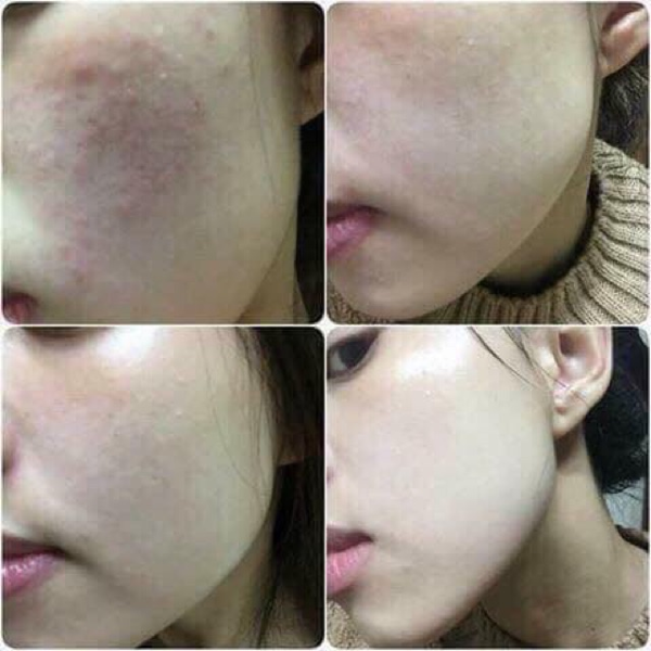 Gel Dưỡng Giảm Sẹo Chiết Xuất Sụn Vi Cá Hồi Hadariki PG Collagen Morepas Care EX 80g
