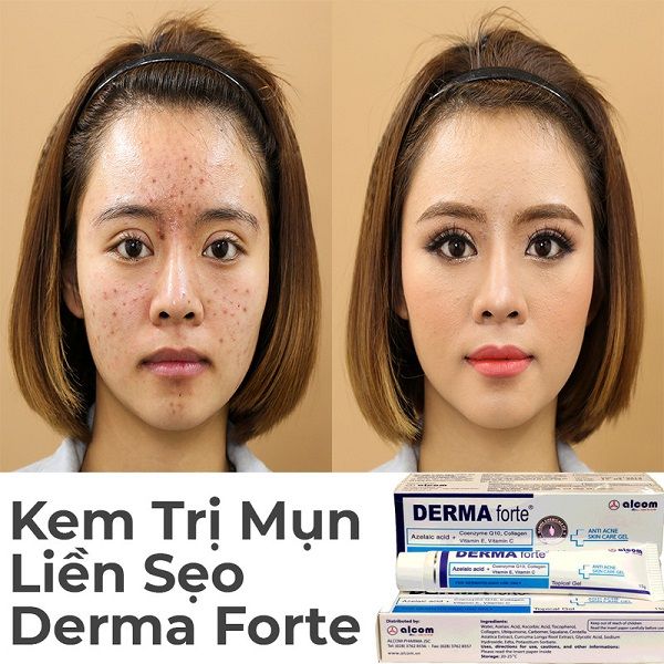 Gel trị mụn trứng cá ngừa thâm mờ sẹo dưỡng da Derma Forte 15g