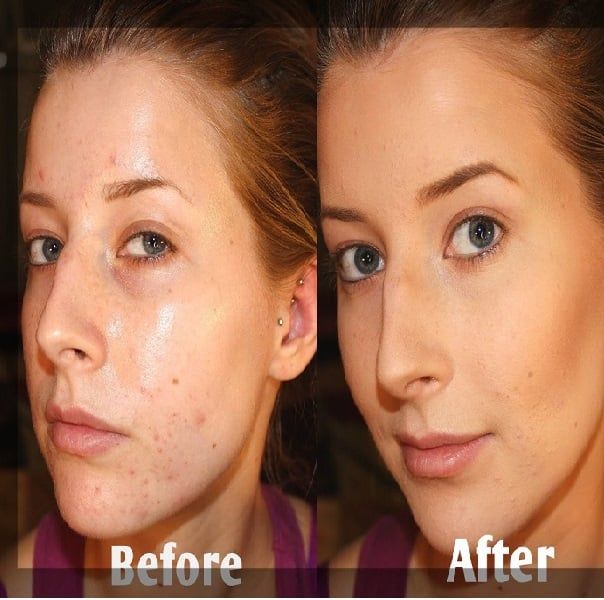 Kem đặc trị Obagi Tretinoin 0.1% 20g