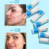 Kem Trị Sẹo Thâm Murad InvisiScar Resurfacing Treatment Jumbo Size 30ml T3E1