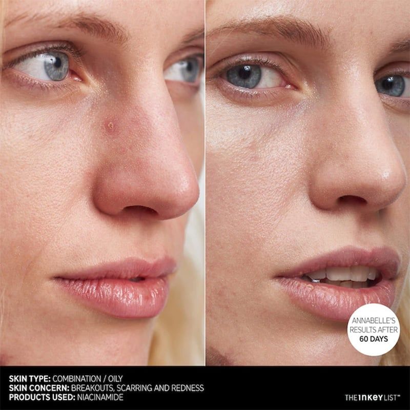 Serum kiềm dầu, giảm mụn, mờ thâm Niacinamide 10% 30ml - The Inkey List (UK - Anh Quốc)