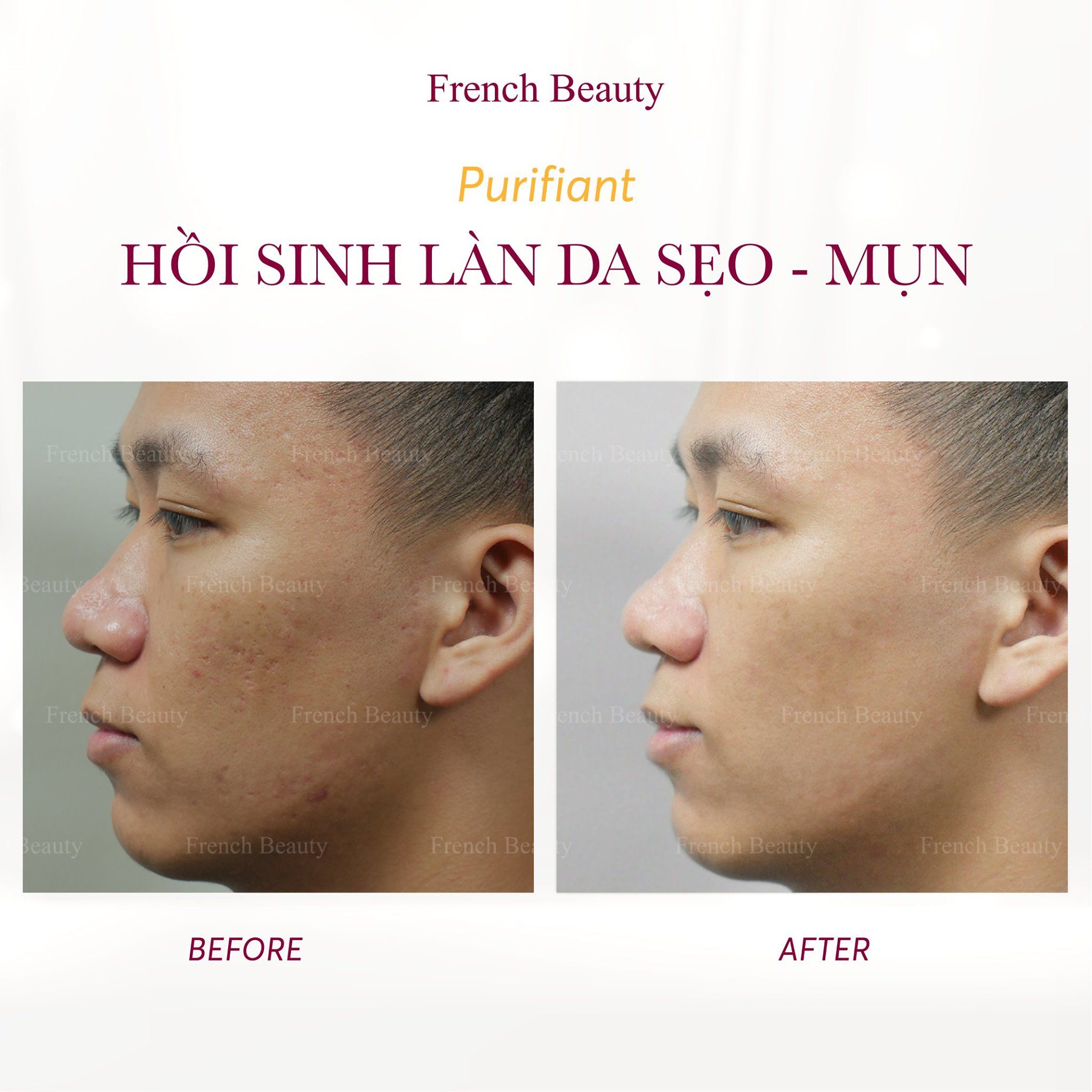 Tinh Chất Tế Bào Gốc Tái Tạo Và Làm Lành Sẹo Rỗ Lâu Năm - FB Complexe purifiant