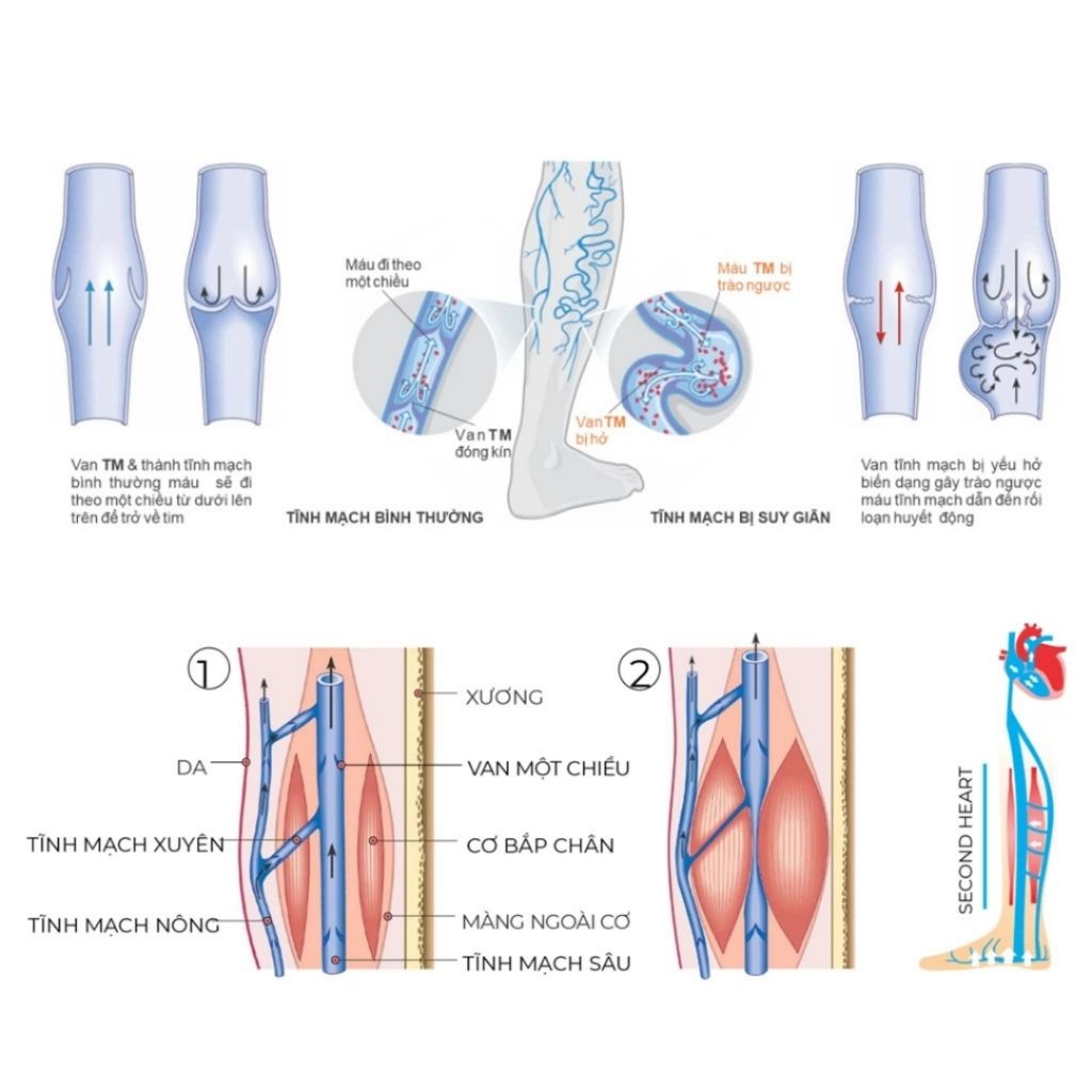 Vớ SANKOM - Giúp giảm suy giãn tĩnh mạch - Dùng cho cả nam và nữ