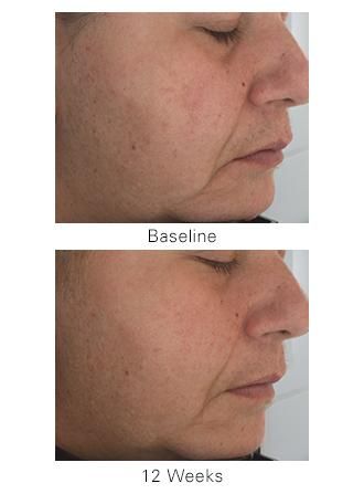 Serum Nâng Cơ Firming Serum Zo Skin Health