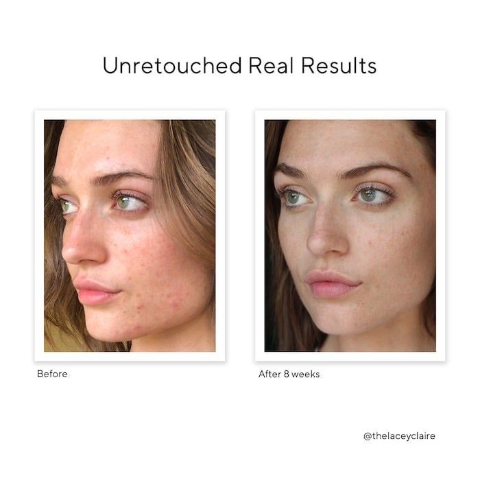 Serum Trị Sẹo Rỗ Và Thâm Mụn InvisiScar Treament Murad