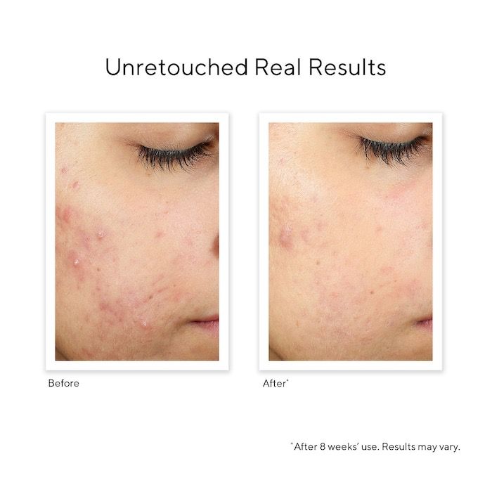 Serum Trị Sẹo Rỗ Và Thâm Mụn InvisiScar Treament Murad