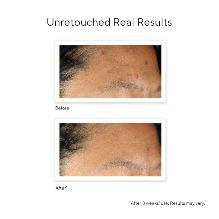 Serum Trị Sẹo Rỗ Và Thâm Mụn InvisiScar Treament Murad
