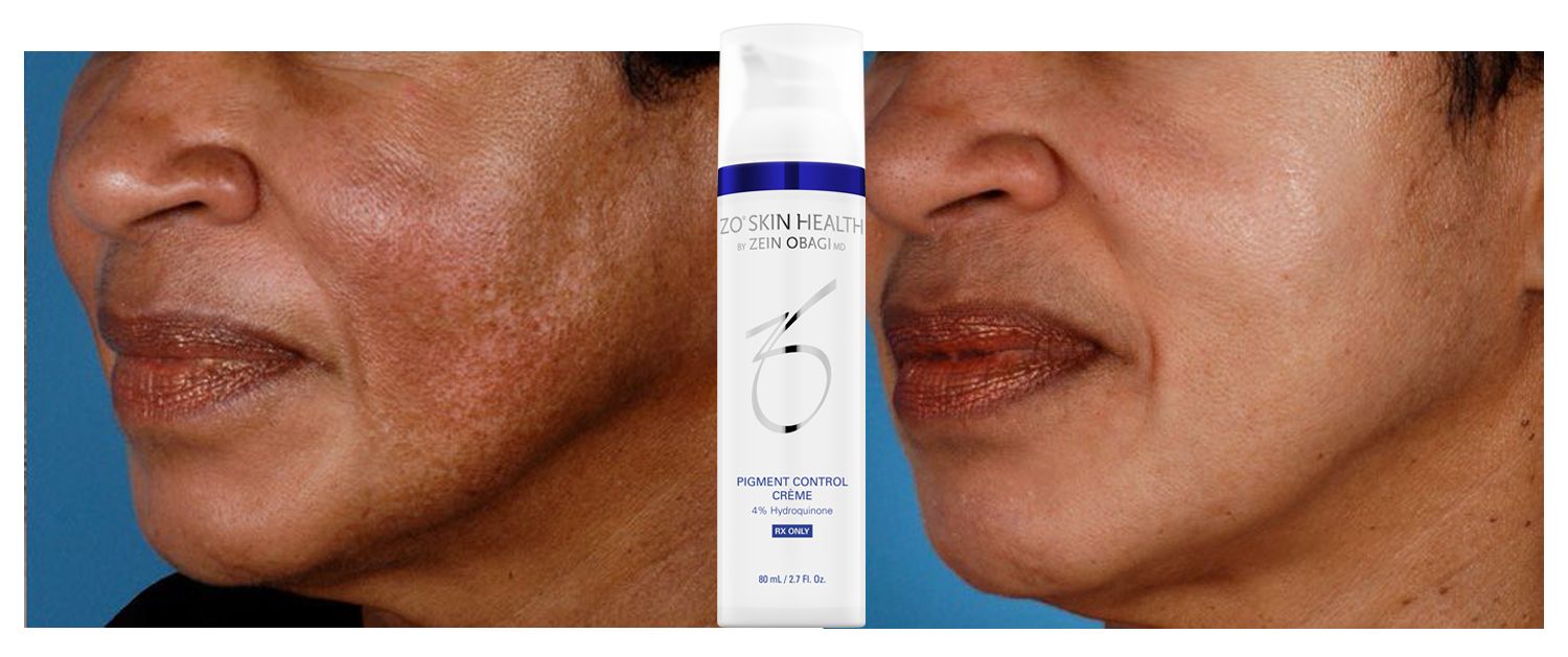 Kem trị nám chuyên sâu Pigment Control Cream 4% Hydroquinone ZO Skin Health