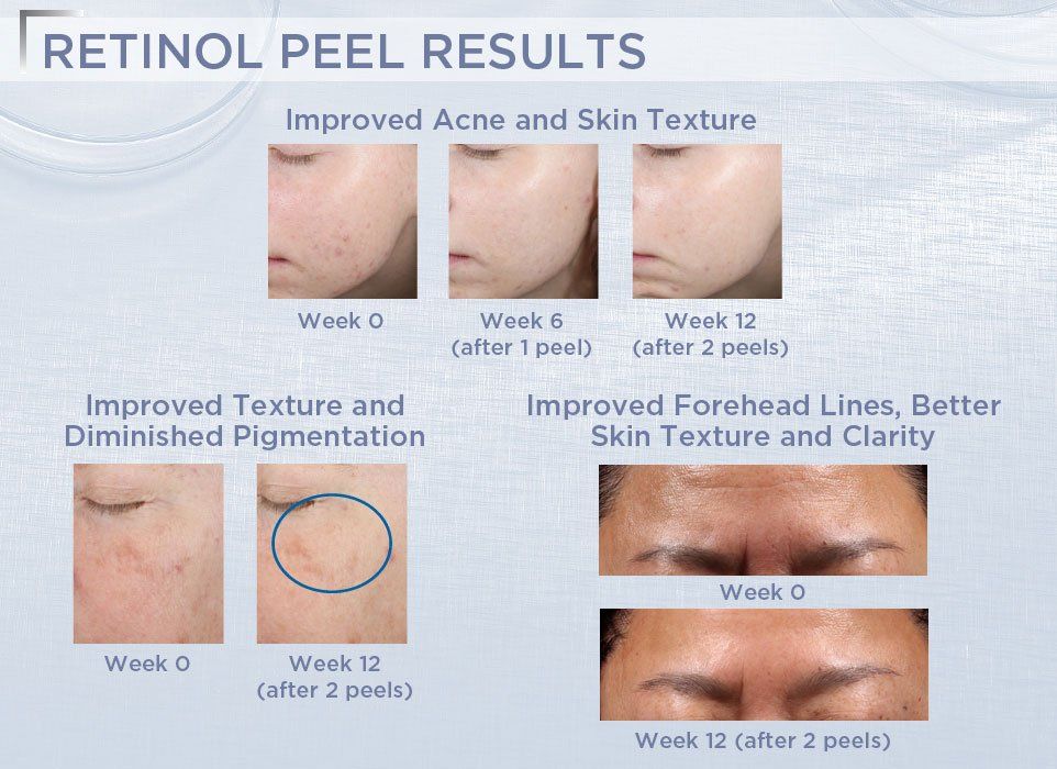 Thay da sinh học NeoStrata ProSystem Retinol Peel