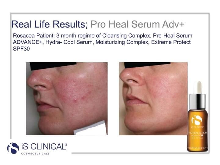 Serum Vitamin C Cho Da Mụn Pro Heal iS Clinical