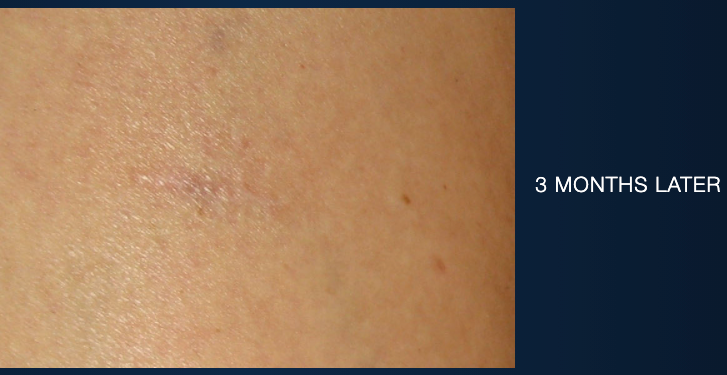 Serum Vitamin C Sáng Da Lành Sẹo Super Serum Advance + iS Clinical