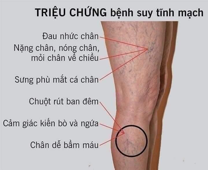 Kem Bôi Giãn Tĩnh Mạch Abtei Venen Aktiv