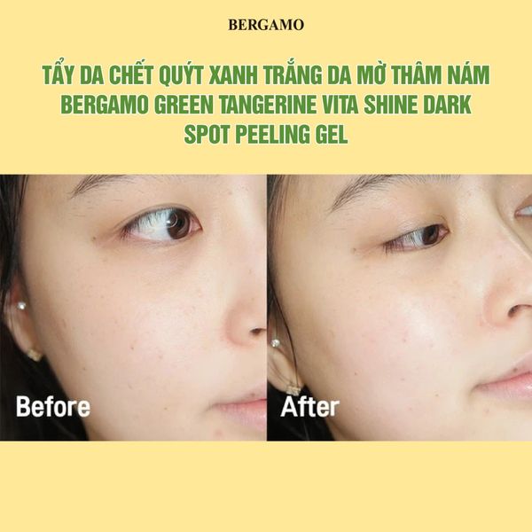 TẨY DA CHẾT QUÝT XANH TRẮNG DA MỜ THÂM NÁM BERGAMO GREEN TANGERIN VITA SHINE DARK SPOT PEELING GEL 150ML