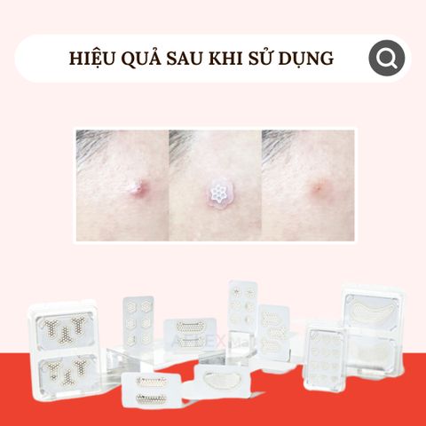  Miếng dán mụn với miếng Magie thần kỳ LAPNPEOPLE tái tạo chăm sóc da 10 miếng 