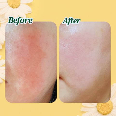  Mặt nạ Miss Dragon - Mặt nạ Collagen hoa cúc - Chăm sóc da mụn, da ửng đỏ, cung cấp collagen giúp da tươi tắn, đàn hồi tràn đầy sức sống (miếng 25 g) 