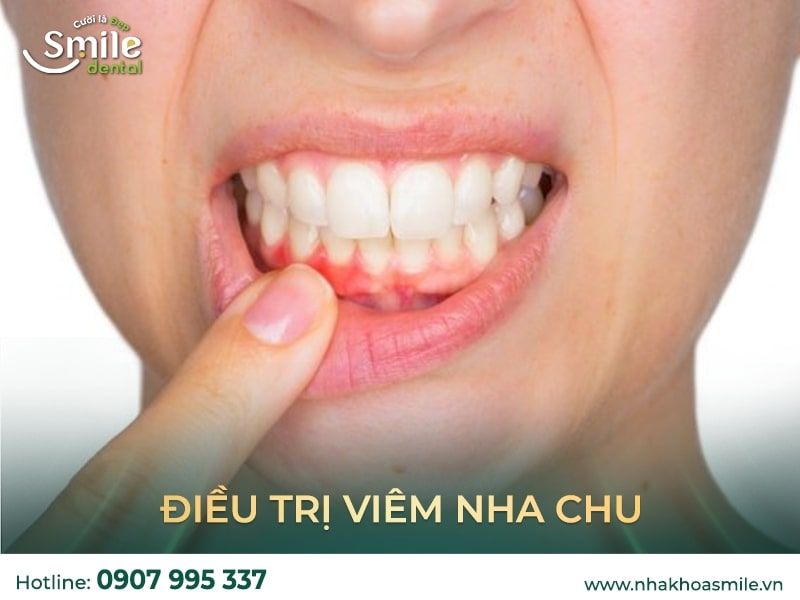 Nha chu Cắt nướu thường