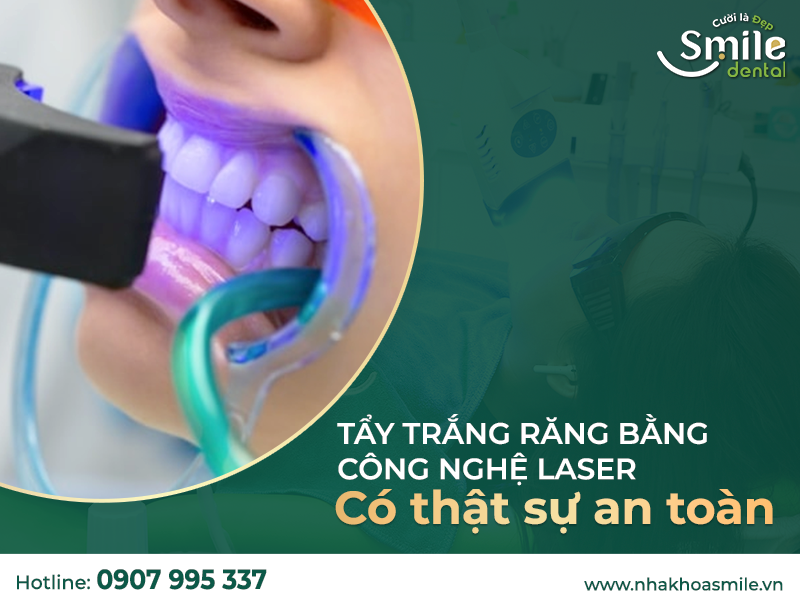 Tẩy trắng răng phòng laser