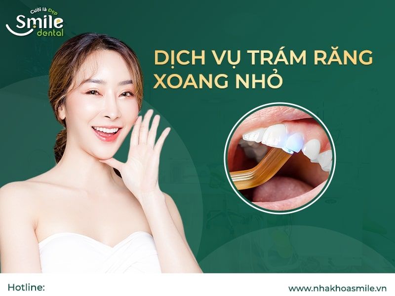 Trám răng thẩm mỹ xoang nhỏ