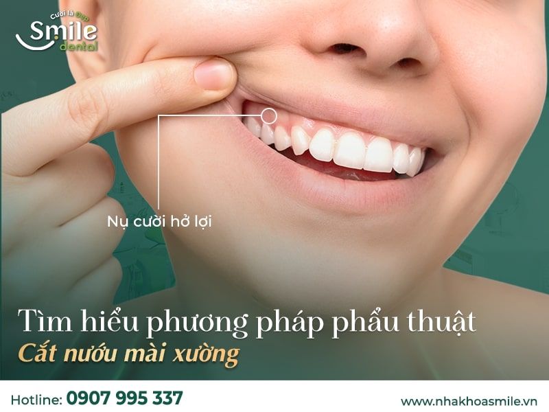 Nha chu cắt nướu mài xương