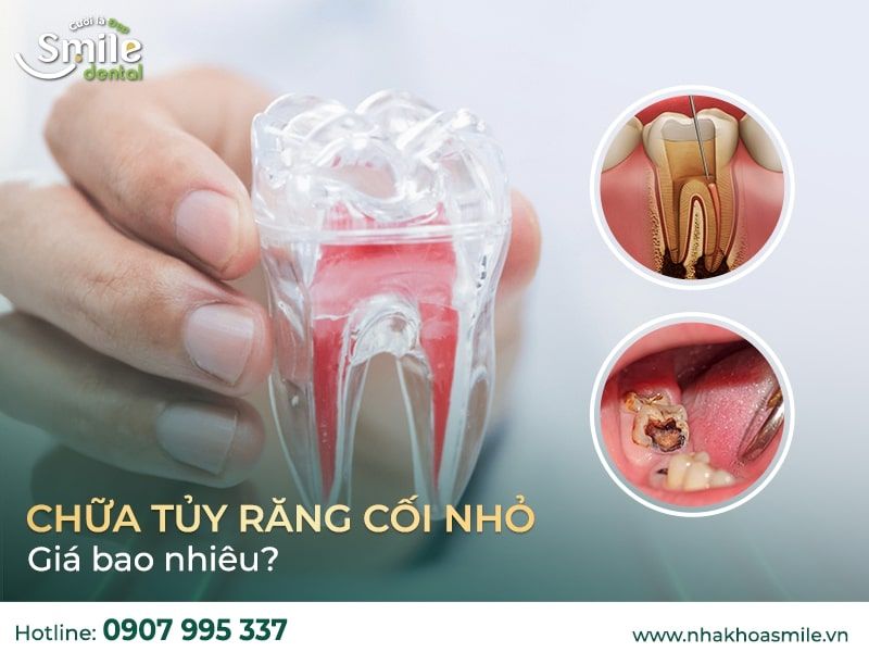 Chữa tủy - Nội nha Răng cối nhỏ