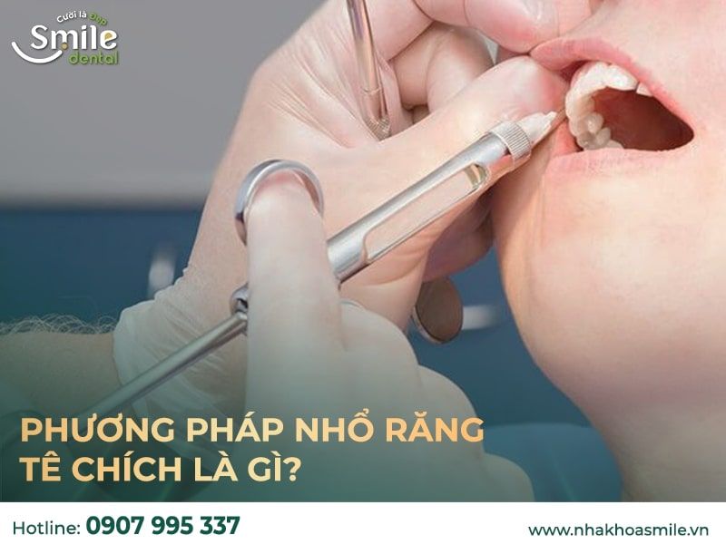 Nhổ răng Răng sữa tê chích