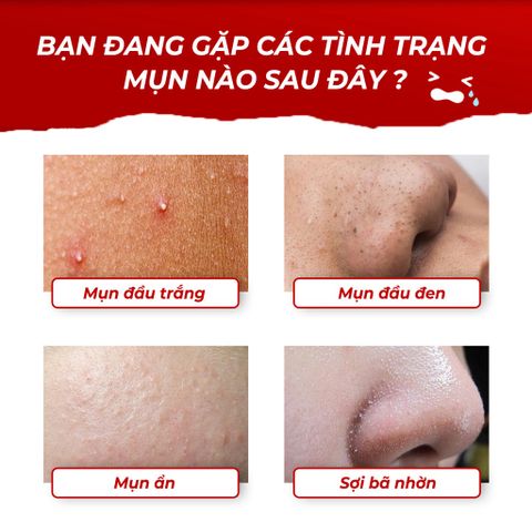 Serum Giảm Mụn Oriskin GenZ White Acne Serum Loại Bỏ Các Loại Mụn Viêm, Trứng Cá Và Mụn Đầu Đen 15ml