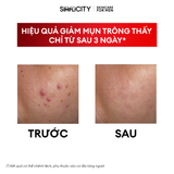 Combo giảm mụn viêm sưng Acne Relief Duo