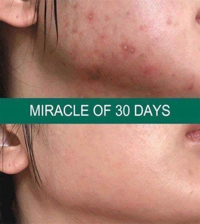Kem Dưỡng Cấp Ẩm Trị Mụn 30 ngày Some By Mi AHA BHA PHA 30 Days Miracle Cream 60g