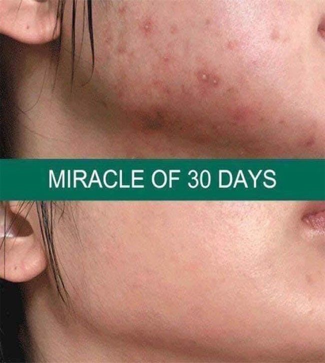 Kem Dưỡng Cấp Ẩm Trị Mụn 30 ngày Some By Mi AHA BHA PHA 30 Days Miracle Cream 60g