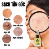 Bộ Tri Mụn ẩn , Mụn đầu đen, Mụn thâm Doctor Care dịu nhẹ dành cho nam nữ da dầu mụn ( Serum 20ml + mặt nạ 50g +sữa rửa mặt 130g)