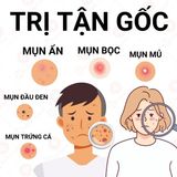  Bộ Tri Mụn ẩn ,Mụn đầu đen,Mụn thâm Doctor Care (Kem 30g + Serum 20ml) 