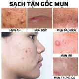  Serum Trị Mụn ẩn, mụn đầu đen cho da dầu tuổi dậy thì Doctor care 