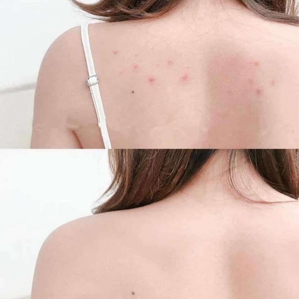 Xà Phòng Trị Mụn Lưng For Back Nhật