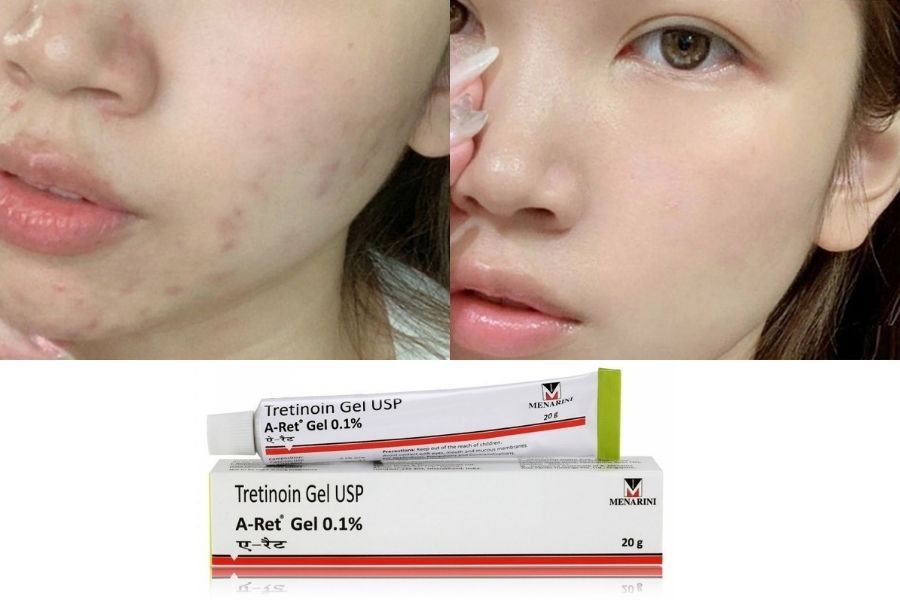 Tretinoin Gel USP A-ret 0.05% Hỗ Trợ Giảm Mụn, Mờ Thâm 20g