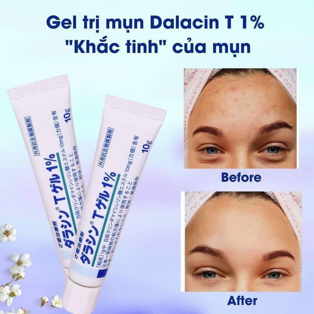 Kem Trị Mụn 1% Dalacin T Gel Nhật Bản 10g