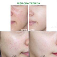 Sữa Rửa Mặt Sạch Sâu, Ngừa Mụn Farmona Dermacos Anti-Acne Deep Cleansing Gel 150ml