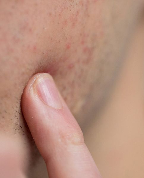 Gel chấm vùng vấn đề giúp chăm sóc nốt mụn lưng chính xác